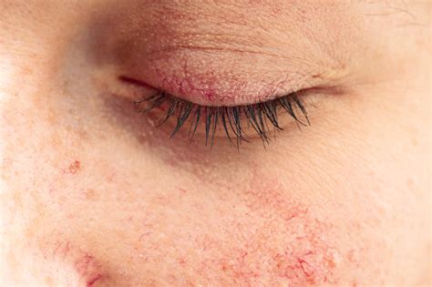 What To Do About Dry Skin Around Eyes And Eyelids Cheneyclinic