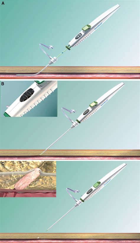 Vascular Closure Devices In Interventional Radiology Practice