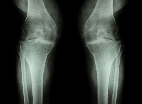 Knee Arthritis Osteoarthritis Treatment Dr Antonis Theodoridis