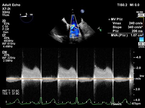 A Funnel Shaped Pannus Formation Above The Mitral Prosthetic Valve