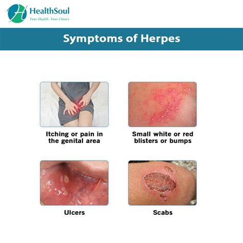What You Need To Know About Herpes Or Hsv Healthsoul