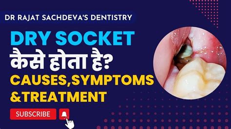 Dry Socket Treatment Dry Socket Wisdom Teeth Symptoms How To
