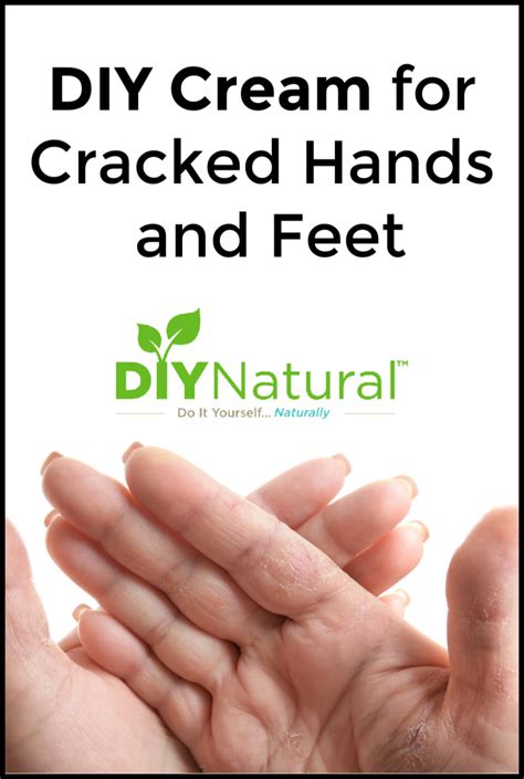 Diy Cream For Dry And Cracked Hands And Feet Cracked Hands Diy Cream