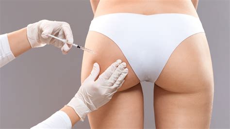 Butt Implants Are Even Riskier Than You Think