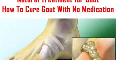 Easy Gout Treatment And Prevention Tips Natural Treatment For Gout