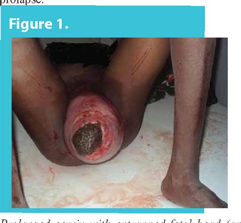 Figure From Uterine Prolapse As An Unusual Cause Of Obstructed Labor