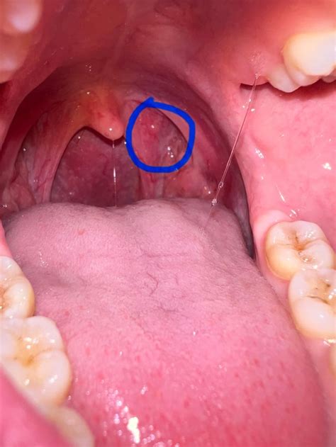 Odd Bump On Throattonsil Area Been There For Over A Month Noticed