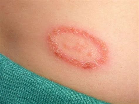 How To Prevent Ringworm