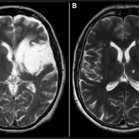 T 2 Weighted Mri Scans Axial View Of Patients Pr A And As B Both