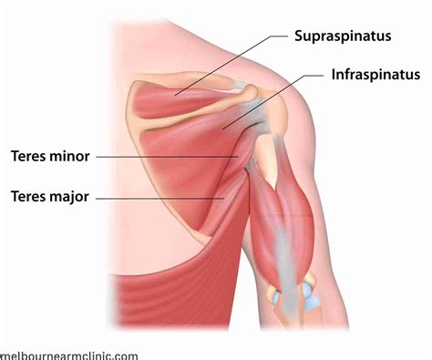 Supraspinatus Tear Causes Treatment Melbourne Arm Clinic