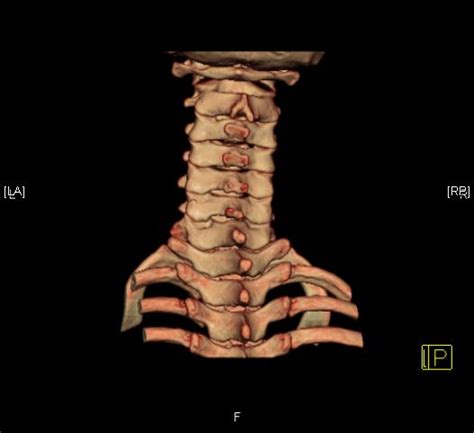 Neurosurgery Traumatic C2 Dens Fracture Type Ii