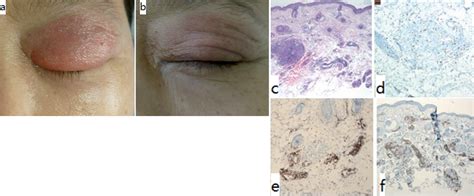 Lymphocytic Infiltration Of The Eyelid Two Cases Responding To