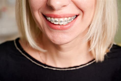 Everything You Need To Know About Adult Braces Greenspoint Dental