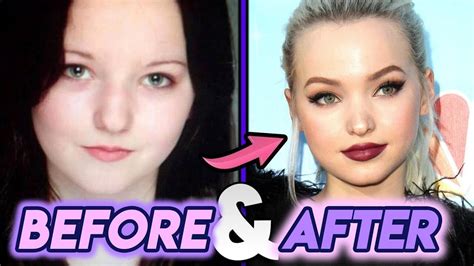 Dove Cameron Plastic Surgery Before After Photos