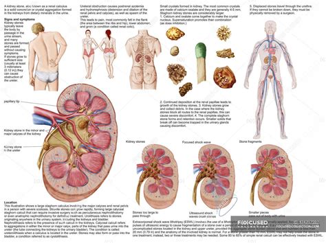 Medical Chart With The Signs And Symptoms Of Kidney Stones — Renal