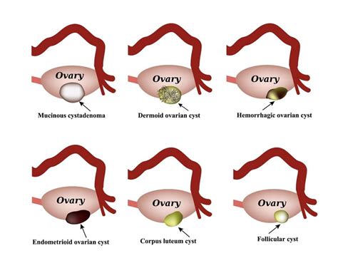 types of ovarian cysts dr micheal tahery