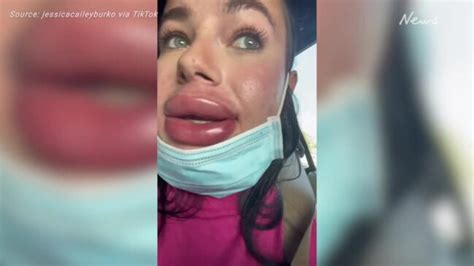 botched cosmetic procedures jessica burko s lip filler injection explodes au