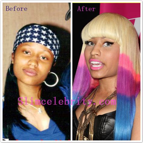 Nicki Minaj Before And After Plastic Surgery Terry S Blog