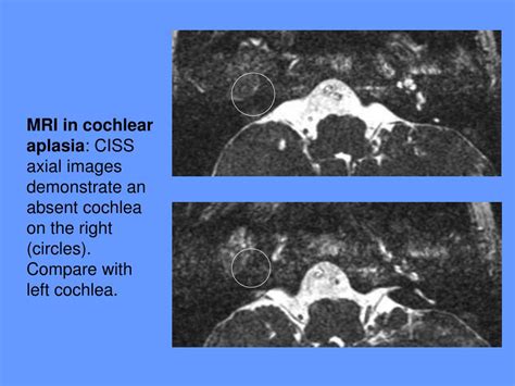 Ppt Congenital And Acquired Hearing Loss A Review With Emphasis On