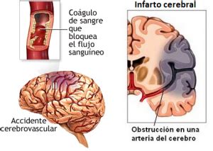 Isquemia Cerebral Cirugía Neurológica Integral de Oriente