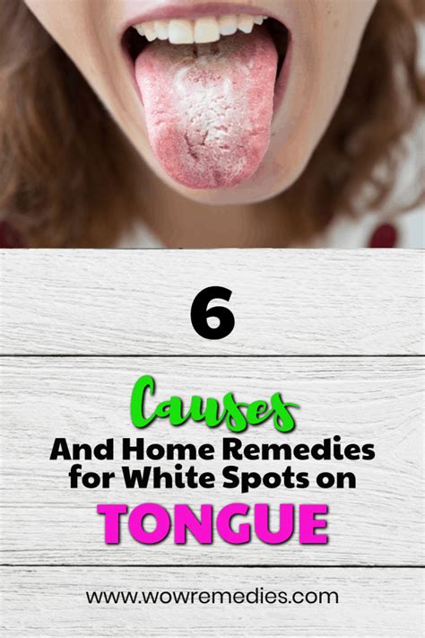White Patches On Tongue White Bumps On Tongue Back Under Tip Side