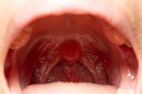 Study Scale Back Surveillance For Hpv Oropharyngeal Cancers Medpage