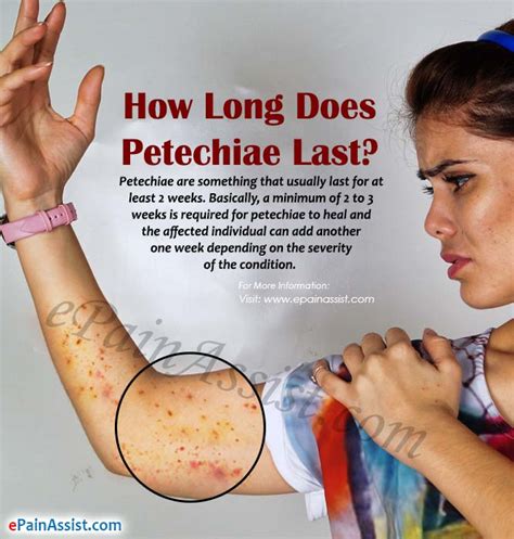 Consider wearing light gloves at night to avoid scratching yourself while you sleep. How Long Does Petechiae Last|Home Remedies to Get Rid of ...