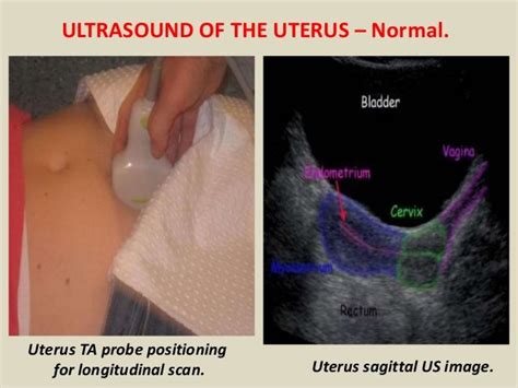 Presentation1pptx Ultrasound Examination Of The Uterus And Ovaries