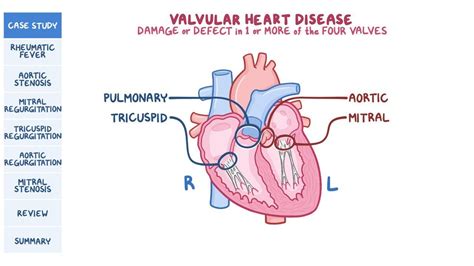 Valvular Heart Disease Pathology Review Osmosis