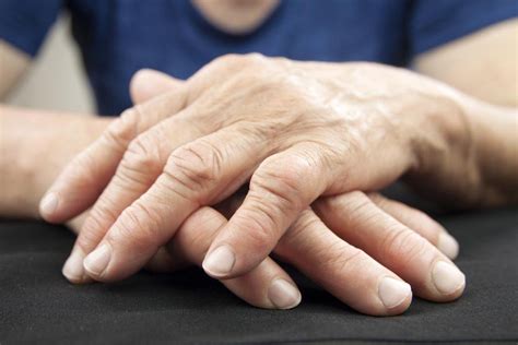 10 Home Remedies For Arthritis In Hands And Wrists