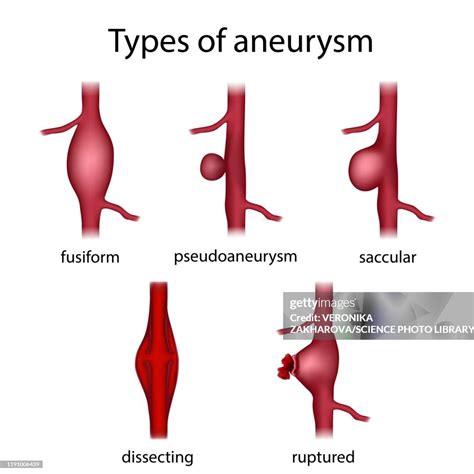 Types Of Aneurysm Illustration High Res Vector Graphic Getty Images