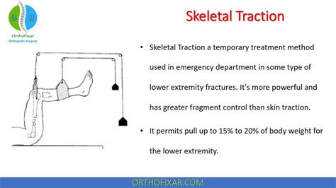 Skeletal Traction Types And Indications Orthofixar 2023
