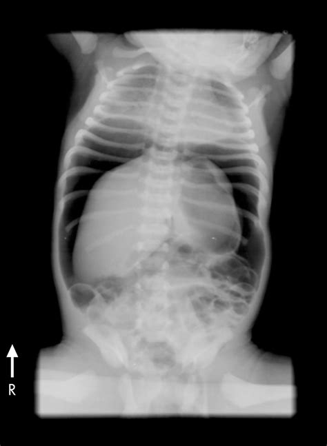 Neonatal Gastric Perforation Following Inadvertent Connection Of Oxygen To The Nasogastric