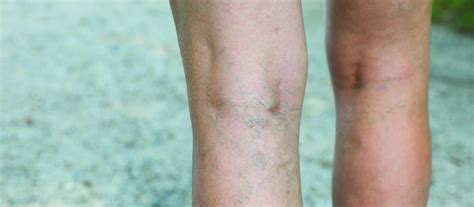 Understanding Varicose Veins What Are The New Treatment Options New