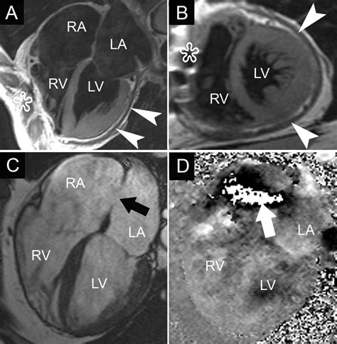 Clinical Applications Of Cardiovascular Magnetic Resonance Imaging Cmaj