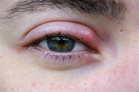 That Red Painful Bump On Your Eye Probably Isnt A Pimple