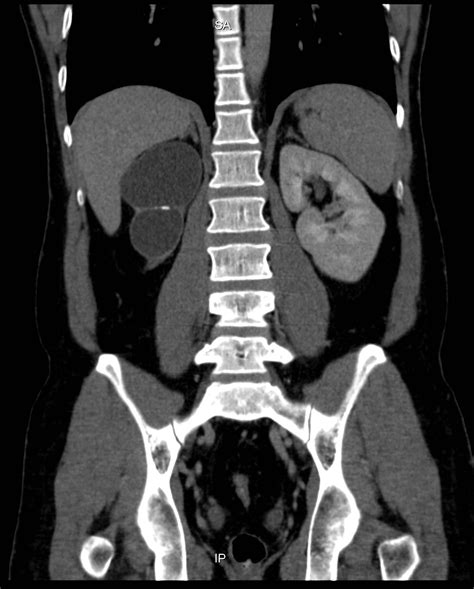 Multicystic Dysplastic Kidney Radrounds Radiology Network