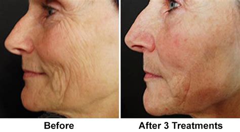Want to microneedle your skin at home with a microneedling pen but don't know where to begin? Microneedling - Paramus, NJ | Create New Collagen