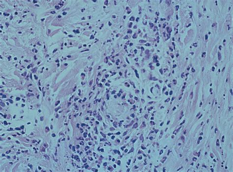 Palpable Purpura In An Asthmatic Woman With Eosinophilia—quiz Case