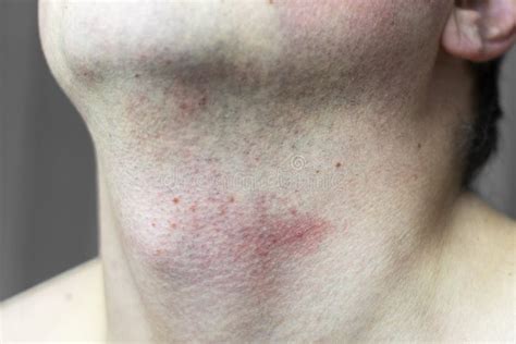 Skin Irritation On Male Neck After Shaving Stock Image Image Of