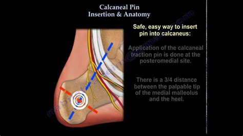 Calcaneal Pin Insertion Anatomy Everything You Need To Know Dr