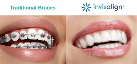 Chalet Dental Care Reveals Key Insights In Orthodontic Choices Invisalign Clear Aligners Vs
