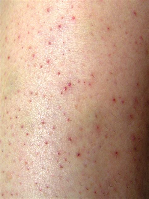 Unknown Cutaneous Manifestations Of Scurvy