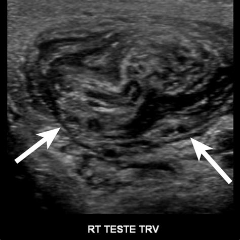 Iame Ultrasound Evaluation Of Acute Scrotal Pain