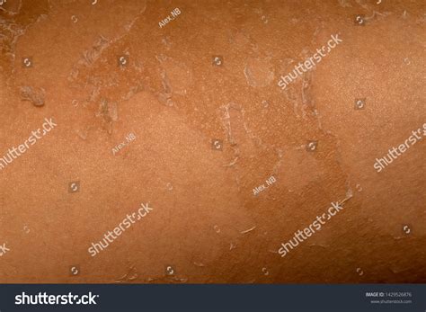 Exogenous Eczema Over 3 Royalty Free Licensable Stock Photos