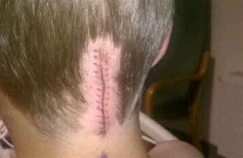 Arnold Chiari Malformation Scar