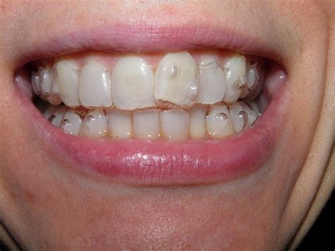 Invisalign braces are some of the fastest to work, but, because no two patients are the same, the treatment may take between 3 to 18 months. We are currently the FIRST and ONLY provider of INVISALIGN ...