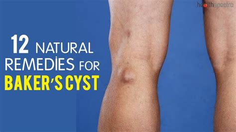 12 Natural Remedies For Bakers Cyst Healthspectra Youtube