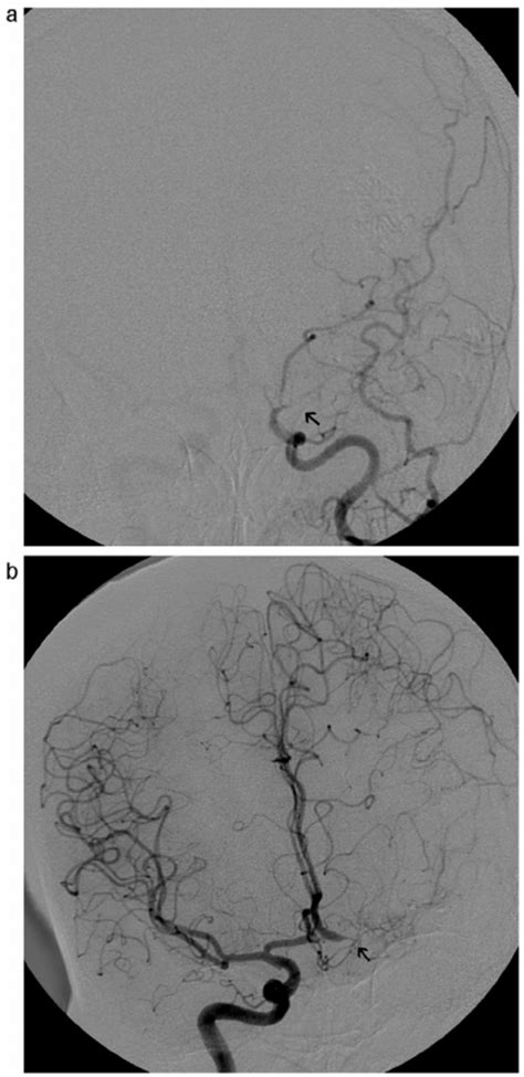 Case 1 Cerebral Angiogram Obtained At 9 Month Follow Up A Ap View