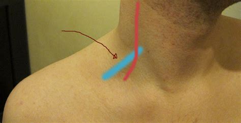 Right Side Of Neck Swollen
